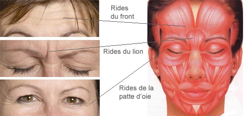 Les rides d'expressions traitées avec le Botox