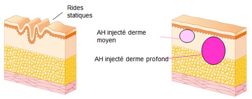 Schéma de l'injection de l'Acide Hyaluronique dans le derme