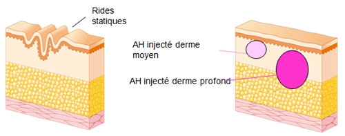 Schéma de l'injection de l'Acide Hyaluronique dans le derme