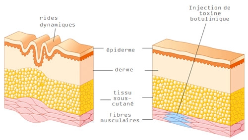 Schéma de l'injection du Botox dans le muscle