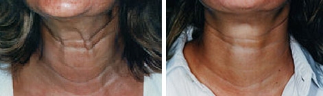 Traitement des cordes platysmales par Botox